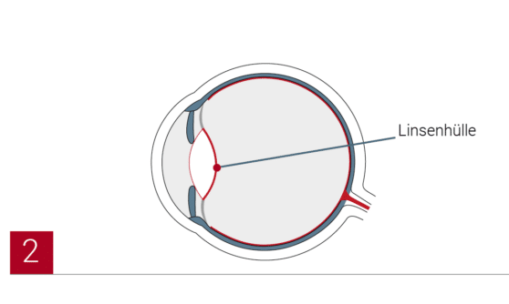 Illustrationen Methoden Grauer Star2