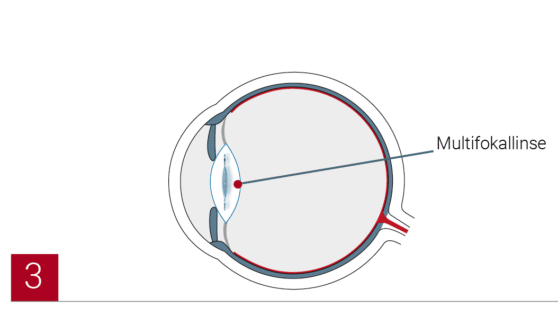 Illustrationen Methoden Grauer Star3