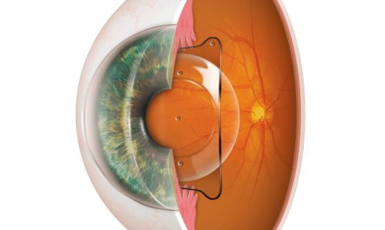 EVO ICL Sitz im Auge transparenter Hintergrund