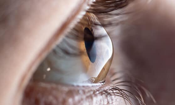 keratoconus1