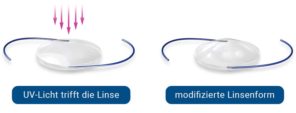 Light-Adjustable-Lens-Linse-vorher-nachher Light Adjustable Lens Linse vorher nachher