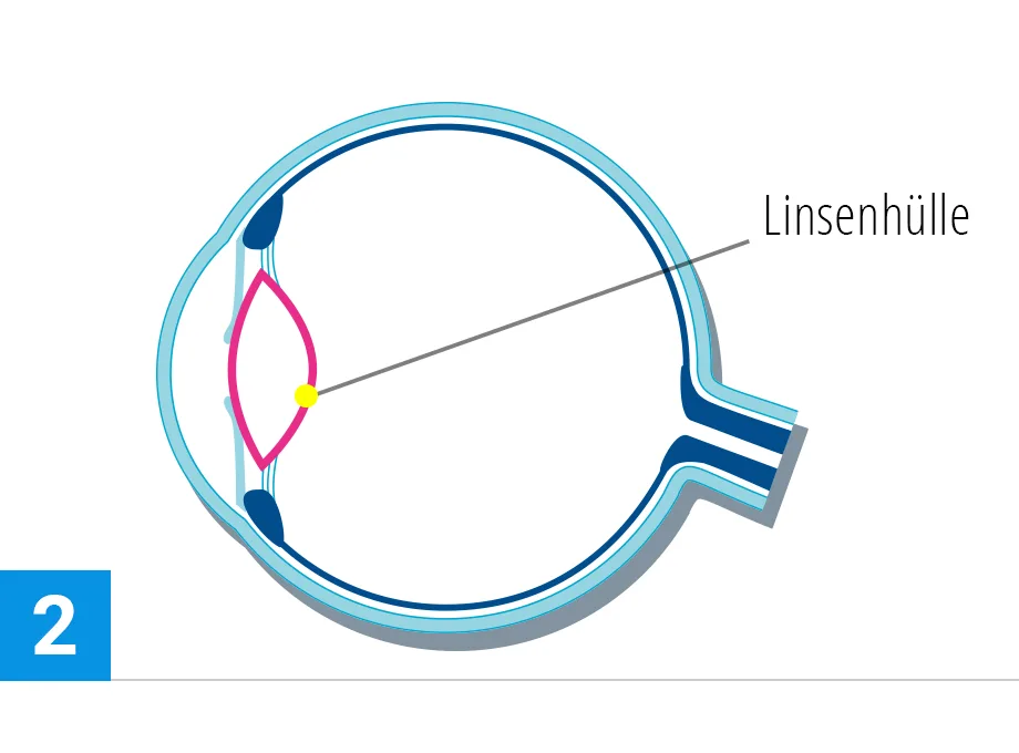 steps verfahren katarakt2